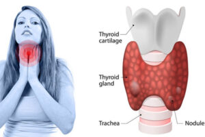 Thyroid-300x200